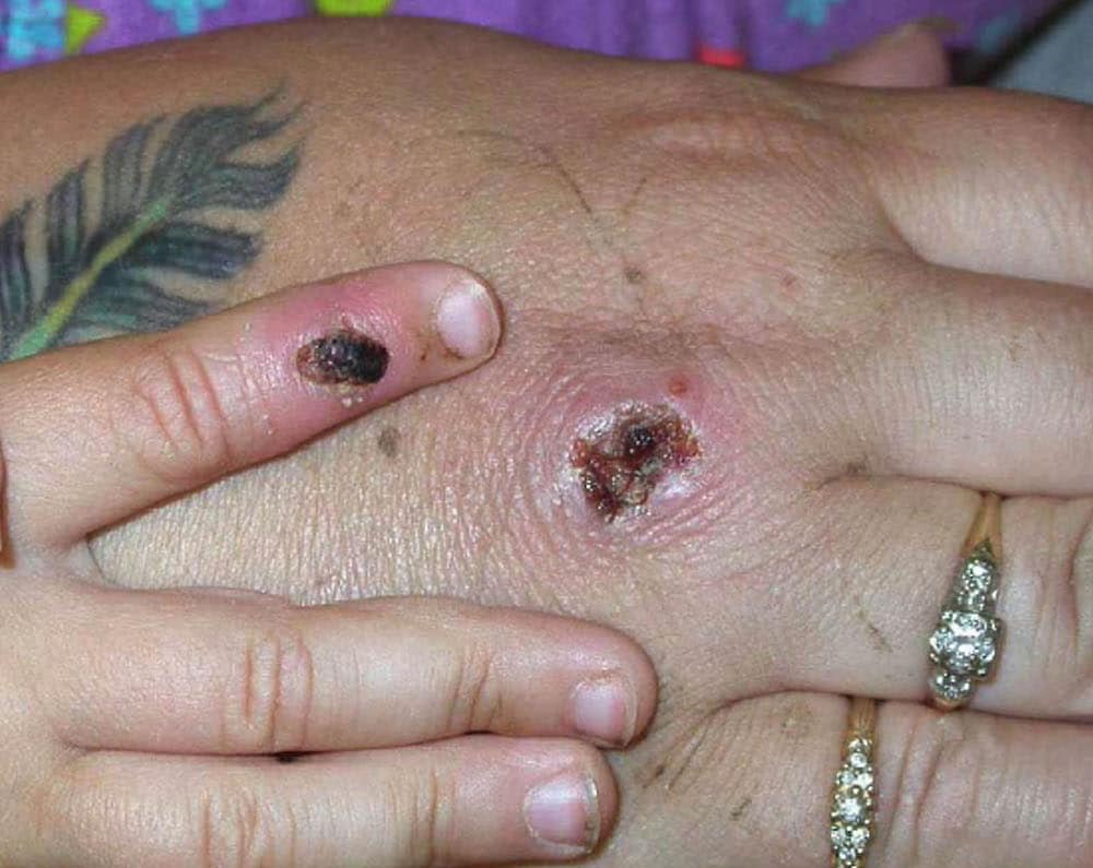 Monkeypox lesions. (Getty/ CDC)